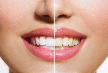 Whitening before and after in lower plenty