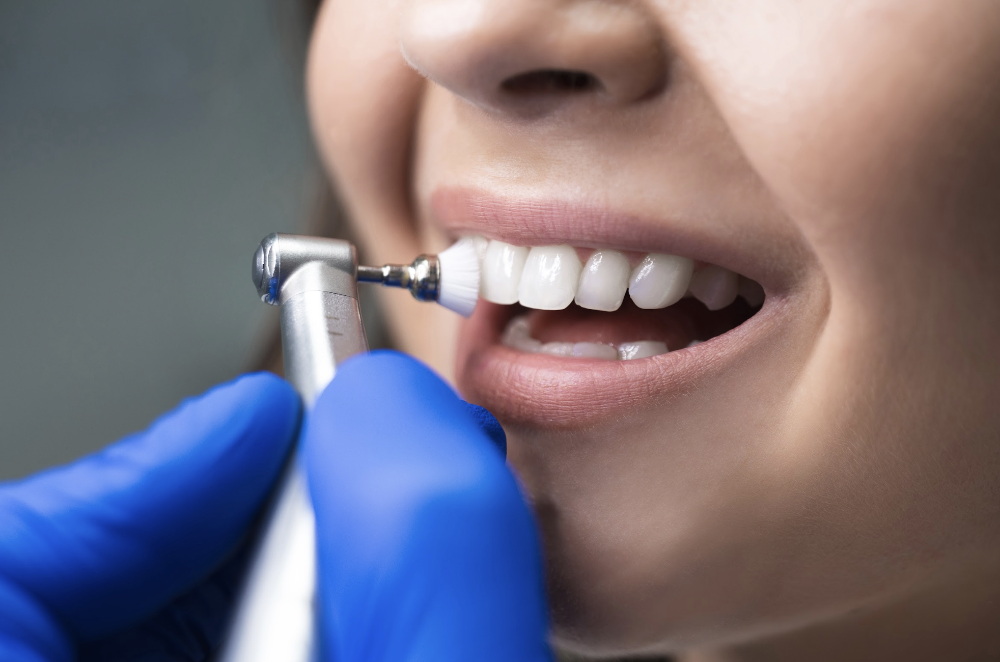 professional teeth whitening lower plenty | dentist polishing teeth