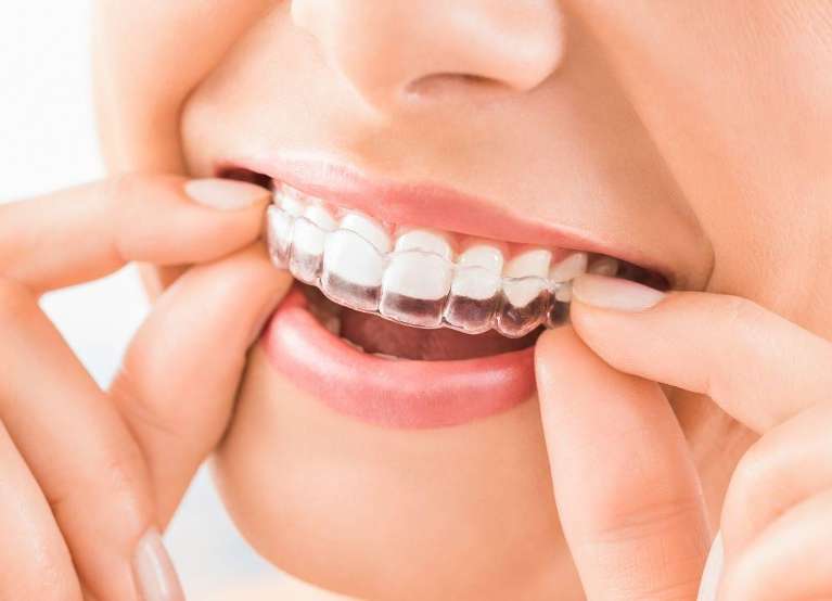 clear braces lower plenty | patient putting in aligner