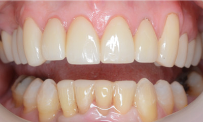 After treatment - Clear Aligners and Crowns/Veneers