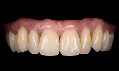 After treatment - Dark Triangle Closure with Composite Veneers