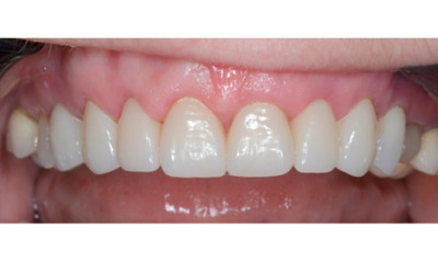 After treatment - Gum Lift, Crown and Veneers