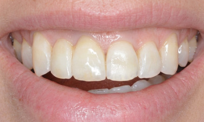 After treatment - Orthodontic and Dental Implant Treatment