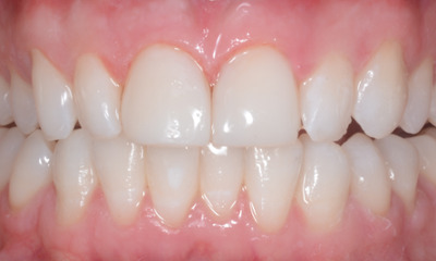 After treatment - Teeth Whitening and Composite Fillings