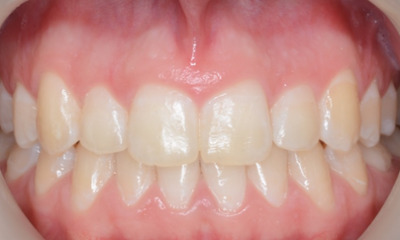 After treatment - Orthodontic Treatment