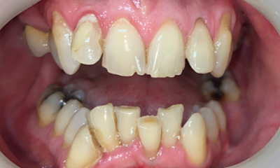Before treatment - Clear Aligners and Crowns/Veneers