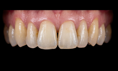 Before treatment - Dark Triangle Closure with Composite Veneers