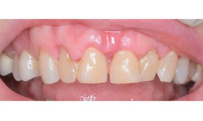 Before treatment - Gum Lift, Crown and Veneers