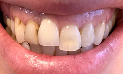 Before treatment - Orthodontic and Dental Implant Treatment