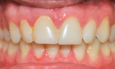 Before treatment - Teeth Whitening and Composite Fillings