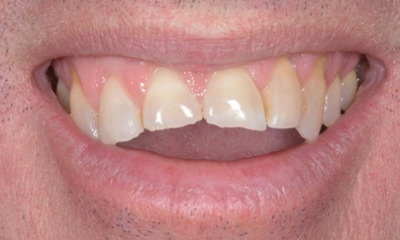 Before treatment - Edge Bonding for Chipped Teeth