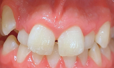 Before treatment - Orthodontic Treatment